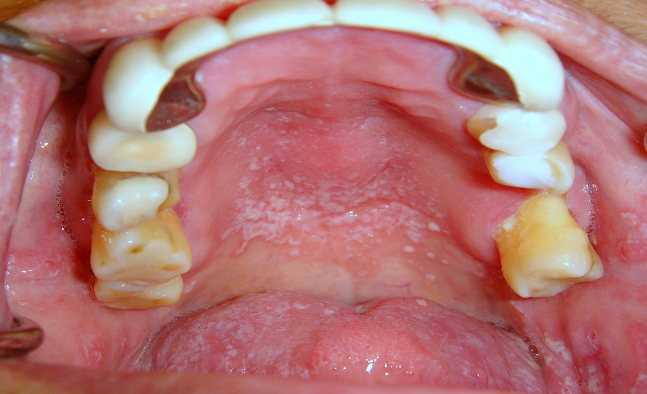 Xerostomia In The Geriatric Patient Causes Oral Manifestations And Treatment Compendium Of Continuing Education In Dentistry May 2016 Rn Inside Dental Hygiene Cdeworld