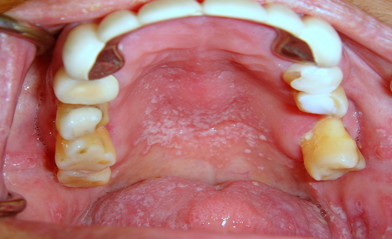 Xerostomia In Elderly