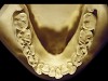 Figure 4  Advanced NCLTS from bruxism, maxillary arch.