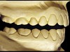 Figure 9  Moderate NCLTS from toothpaste, right facial view.