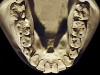 Figure 16  Moderate NCLTS from regurgitation, mandibular arch.