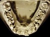 Figure 20  Moderate NCLTS from soda-swishing, mandibular arch.