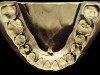 Figure 23 Advanced NCLTS from soda-swishing, mandibular arch.