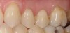 Figure 5  The root surface on the maxillary left first molar has responded to remineralization therapy and appears shiny. This caries-resistant surface will feel hard, smooth, and glass-like when palpated with the side of an explorer. These patients often notice a marked reduction in dentinal hypersensitivity.