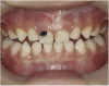 Fig 5. Use of 38% SDF to arrest coronal caries in primary teeth of a young child. The arrested carious lesion had a hard, blackened, and impermeable layer.