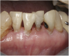 Fig 6. Use of 38% SDF to arrest root caries in permanent teeth of an elderly patient: the arrested root carious lesions were hard to probe.