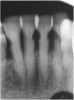 Fig 7. Use of 38% SDF to arrest root caries in permanent teeth of an elderly patient: the lower incisors were responsive to electric pulp testing with no radiographic pathology.