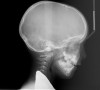 (22.) Radiograph highlights the obstructed nasal airway preoperatively. Three months after T&A, another PSG demonstrated an AHI of 0.3 and RERA of 0.0/hr.