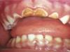 Figure 4  Classic early childhood caries demonstrating massive destruction of maxillary anterior teeth.