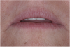 (18.) The provisional restorations show the vertical and horizontal changes in the incisal edge position.