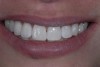 (13.) Final postoperative photograph. Note the minimally invasive, imperceptible restorations.