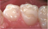 Fig 1. 9-year-old patient with proximal caries lesions of canine and  rst molar.