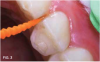 Fig 3. SDF applied with  exible proximal pick.