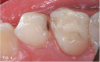 Fig 4. Caries lesion of canine, a few minutes after SDF applied.