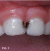 Fig 7. 3 months after SDF application, before renewed application.