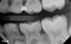 Fig 8. 10-year-old patient with distal caries lesion of primary  rst molar. (