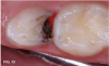 Fig 10. 3 months after SDF application, no additional treatment needed.