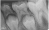 Fig 11. 3 months after SDF application, no additional treatment needed.