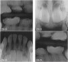 Fig 12. 5-year-old patient with dentinogenesis imperfecta had caries lesions of three primary  rst molars and the maxillary right canine tooth.
