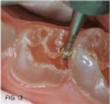 Fig 13. A layer of carious tooth substance debrided painlessly.