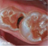 Fig 16. Several weeks later, caries lesions are dark black.