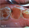 Fig 17. Several weeks later, caries lesions are dark black.