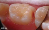 Fig 19. Caries lesion exposed with diamond bur slice.