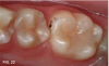 Fig 22.  7 months after SDF treatment, second molar had exfoliated.