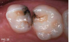 Fig 23. 8 months after single SDF applications in previously restored teeth in an 11-year old.