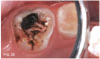 Fig 25. After two SDF applications in a primary second molar that had a dentoalveolar abscess.