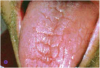 Fig 1. Fissured/lobulated tongue.