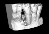 Fig 4. A 3D printed scaffold was designed using CAD software to fit a peri-osseous defect in a human patient. The scaffold consisted of a region with channels designed to support oriented PDL tissue formation and a region for the regeneration of osseous tissue. Fig 3: baseline; 
Fig 4: defect model; Fig 5 through Fig 7: internal, tilted, and side views of scaffold, respectively; Fig 8 through Fig 10: coronal, middle, and apical 
angles, respectively; Fig 11: cross-section diagram; Fig 12: labial scan image. (Images reprinted with permission from Rasperini G, Pilipchuk SP, Flanagan CL, et al. J Dent Res. 2015;94[9 suppl]:153S-157S.)