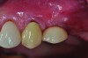 Clinical view of a maxillary left second premolar in an 73-year-old patient with a history of smoking. The tissue around the implant is quite inflamed and probes up to 8 mm with bleeding.