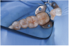 Fig 1. Clinical presentation with no detectable fissure to probing. Blue marks indicate occlusion.