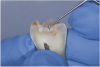 Fig 5. Example of explorer tip damaging decalcified tooth structure, possibly accelerating the caries process. Only slight chalkiness was visible when wet, but firm pressure broke through as seen.