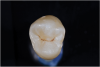 Fig 6. ICDAS code 0: Clinical appearance of stained fissure with no evidence of shadow or decalcification after drying.