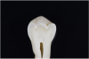 Fig 7. ICDAS code 0: Sectioned tooth confirms stain not indicative of carious penetration of fissure.