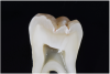 Fig 11. ICDAS code 2: Tooth in Fig 10 sectioned to show penetration into outer third of dentin.