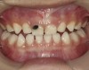 Fig 5. Use of 38% SDF to arrest coronal caries in primary teeth of a young child. The arrested carious lesion had a hard, blackened, and impermeable layer.