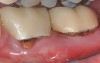 (12.) Pretreatment photograph of two previously restored teeth exhibiting gingival recession and probing depths equal to or greater than 15 mm.