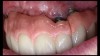(16. and 17.) Photograph of failing implant prosthetics that may require specialty care taken with a smartphone and an EALS device.