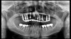 (16. and 17.) Photograph of failing implant prosthetics that may require specialty care taken with a smartphone and an EALS device.