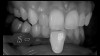 (18. and 19.) Tooth shade analysis of value, chroma, and hue taken with a smartphone and an EALS device.