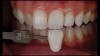 (18. and 19.) Tooth shade analysis of value, chroma, and hue taken with a smartphone and an EALS device.