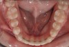 Figure 12 Patient with a bonded retainer on the lower anterior teeth for “lifetime” retention.