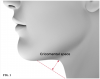 (1.) Cricomental space measurement.