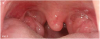 (5.) Enlarged tonsils.