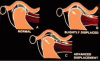 Fig 2. If patients have difficulty moving the mandible laterally, it is likely an indication of TMJ disc displacement or condyle/fossa misalignment, regardless of symptoms.