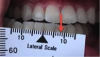 Fig 4. A right lateral mandibular movement of 8 to 12 mm.