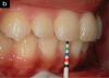 Fig 6. Decreased overbite and increased overjet from the initial examination record (3 mm or more, per author’s protocol) may suggest a TMJ disc displacement, even if symptoms or clicking/popping have not yet appeared.